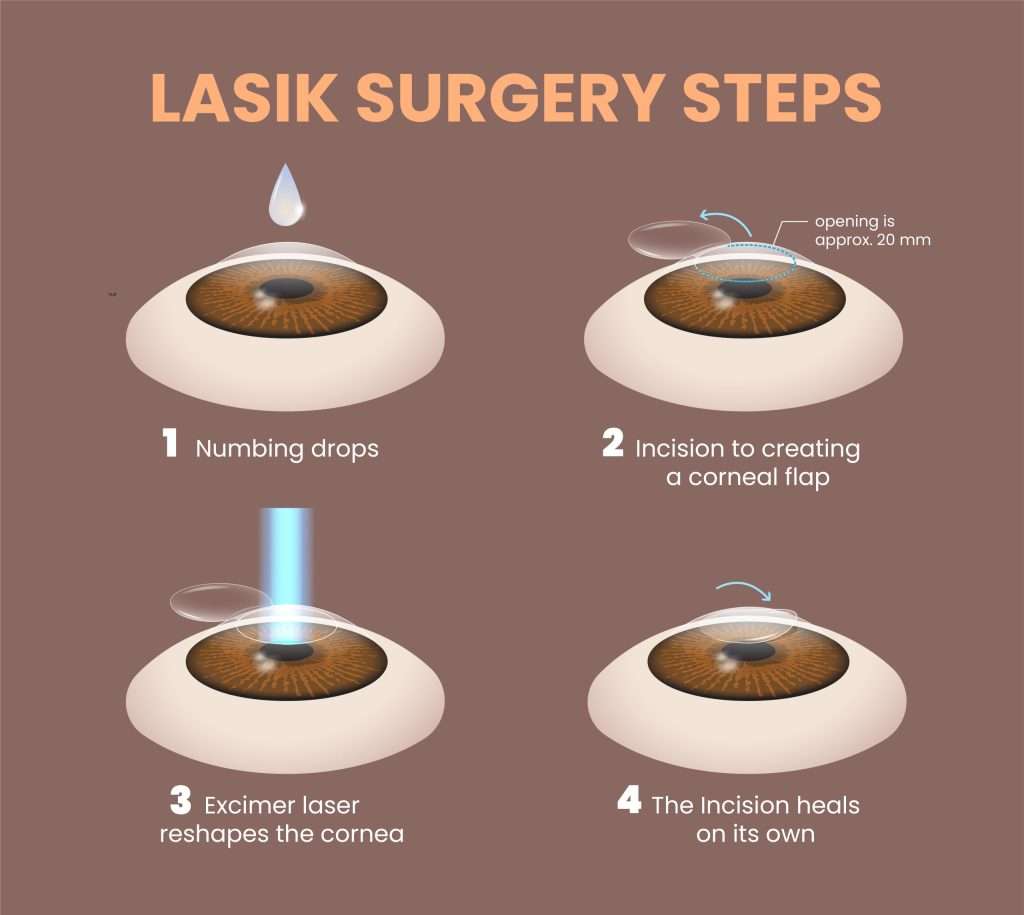 lasik surgery steps