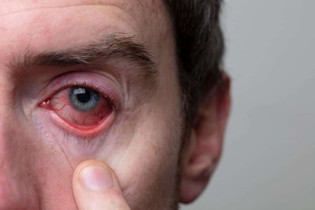 blepharitis with red eye
