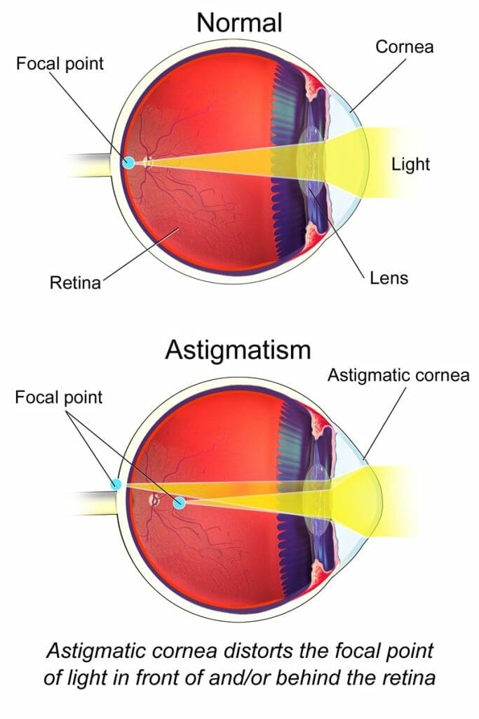 cornea astigmatism