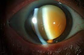 late stage cataract requiring surgery