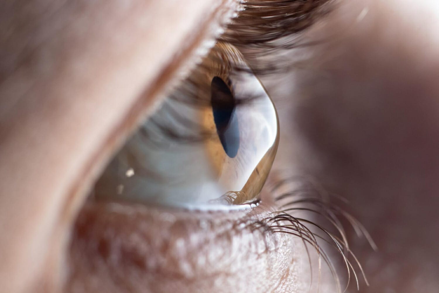 keratoconus eye needing cornea cross linking surgery