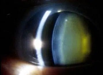 nuclear sclerotic cataract