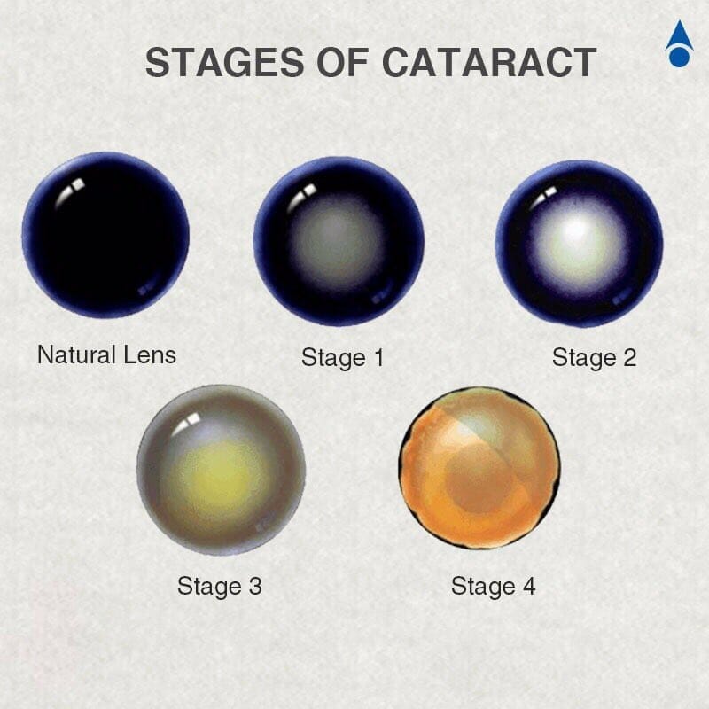 cataract stages
